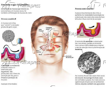 Entenda o que  a sinusite
