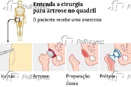 Entenda a cirurgia para artrose no quadril