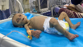 Palestinian toddler battles with malnutrition in Gaza