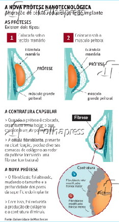 A nova prótese nanotecnológica