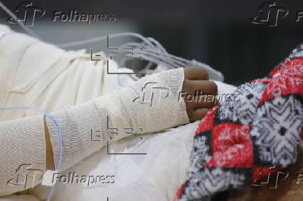 Expertos alertan de quemaduras en adolescentes en México por bromas o pugnas del crimen