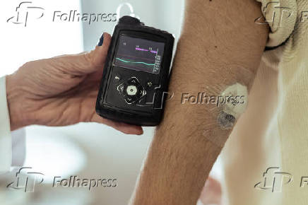 Sensor e bomba de insulina auxiliam no controle do diabetes