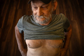 A coal miner shows scar from lung transplant in Cedar Bluff, Virginia