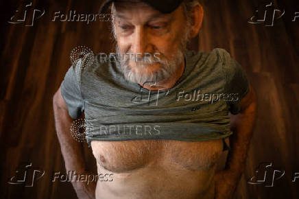 A coal miner shows scar from lung transplant in Cedar Bluff, Virginia