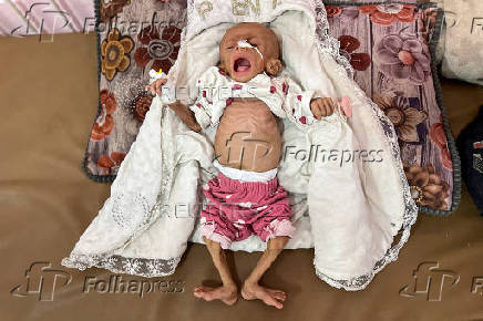 Zainab Abu Haleeb, a five-month-old Palestinian girl diagnosed with malnutrition, according to medics, receives treatment at Nasser hospital in Khan Younis, in the southern Gaza Strip