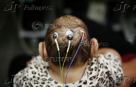 The Wider Image: Twins - one with microcephaly