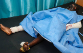 An injured woman recovers in a hospital bed following a drone strike