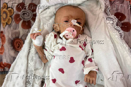 Zainab Abu Haleeb, a five-month-old Palestinian girl diagnosed with malnutrition, according to medics, receives treatment at Nasser hospital in Khan Younis, in the southern Gaza Strip